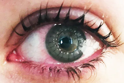 Cornea Ocular Surface