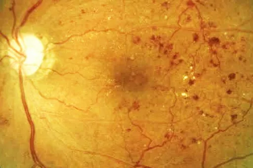 Medical-Retina